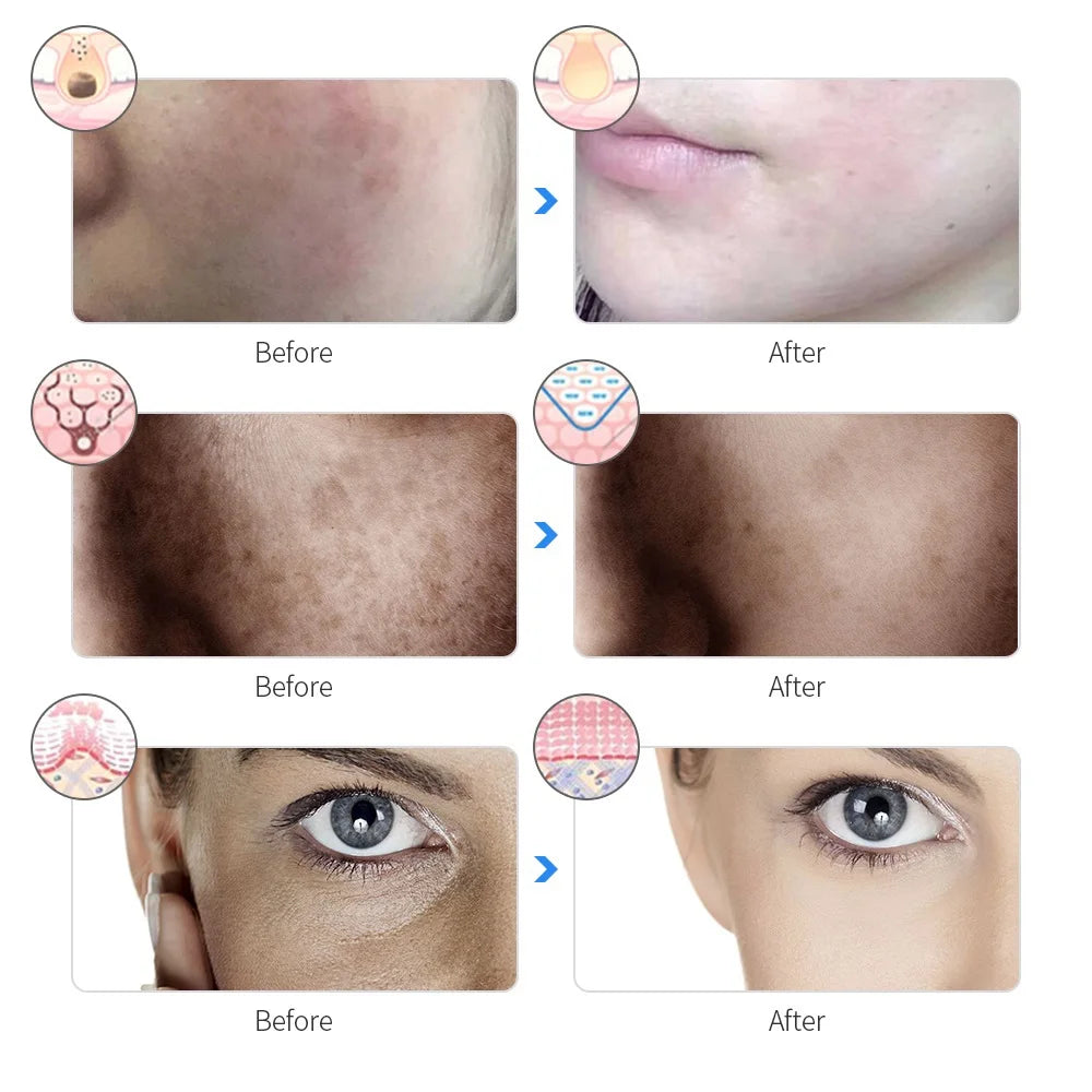 SoftSkin LED Therapy Mask